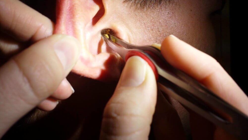 Manual Removal The Ear Wax Removal Specialists UK